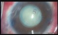 Preventing Argentinian Flag- Intumescent Cataract
