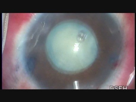 intumescent cataract