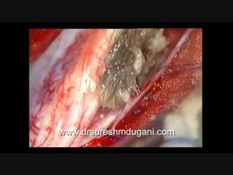 Intra Spinal Dermoid