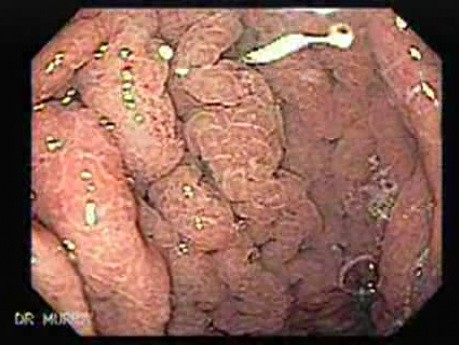 Eosinophilic Gastritis (2 of 2)