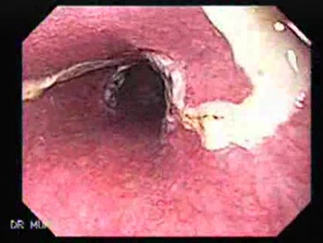 Gastric Varices - Endoscopic Ablation With Cyanoacrylate Glue (16 of 18)