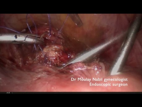 Laparoscopic Management of Isthmocele