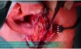 Ostheosyntesis of Mandibular Condyle Base Fracture