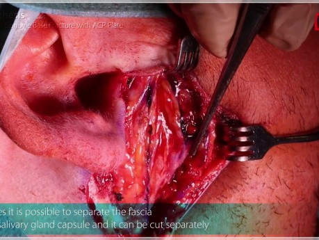 Ostheosyntesis of Mandibular Condyle Base Fracture