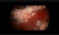 Thoracoscopy In The Treatment of Pleural Empyema in 2,5 Year Old Girl