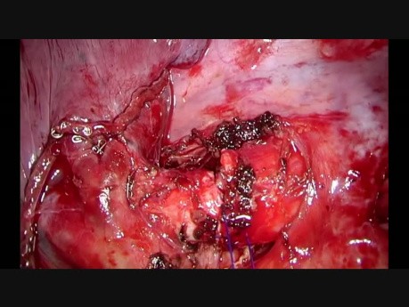 Unisurgeon Uniportal Vats Sleeve Lobectomy With Robotic Arm and Voice Control (Non Edited)
