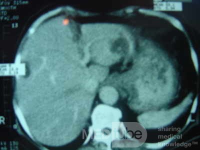 ScirrhousGastric Carcinoma (Linitis Plastica) (13 of 15)