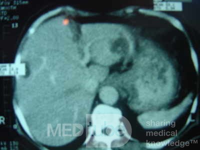 ScirrhousGastric Carcinoma (Linitis Plastica) (13 of 15)