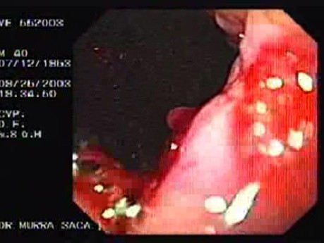 Acute Variceal Bleeding - Visualization of Bleeding