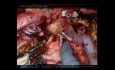 Robotic Whipple (AHPBA 2019)