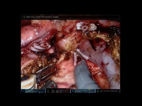 Robotic Whipple (AHPBA 2019)