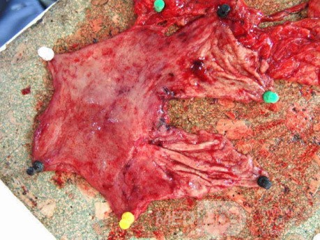 Small Gastric Adenocarcinoma of the Diffuse Ring Cell (9 of 19)