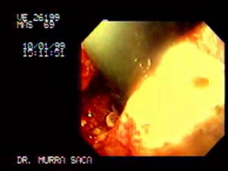 Adenocarcinoma of the Fundus