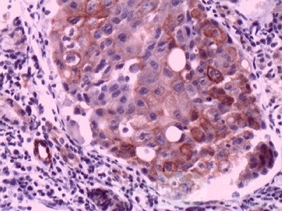 Ovarian Carcinoma Metastatic to Stomach and Duodenum (19 of 20)