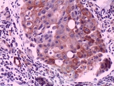 Ovarian Carcinoma Metastatic to Stomach and Duodenum (19 of 20)