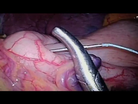 The Role of The Valve Mechanism During Fundoplication