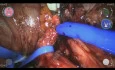 Psoic Bladder with Ureteral Reimplantation