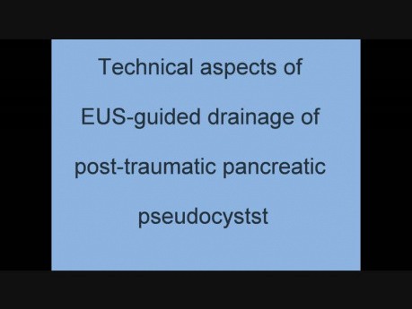 Technical aspects of EUS-guided drainage of post-traumatic pancreatic pseudocyst