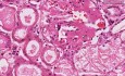 Amyloidosis - Kidney - Histopathology