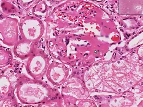 Amyloidosis - Kidney - Histopathology