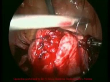 Excision of Leiomyomas