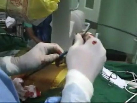 Percutaneous Nephrolithotomy - kidney stones removal