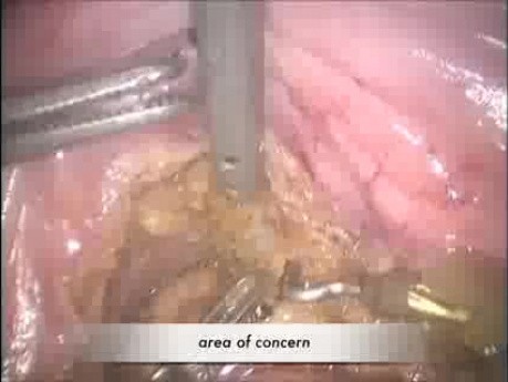 Robotic Total Mesorectal Excision Advantage in Advanced Rectal Cancer  
