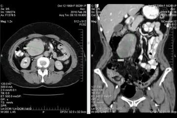 Laparoscopic Excision Biopsy of Mesenteric Liposarcoma 