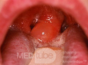 Acute Edema of the Uvula