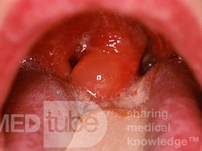 Acute Edema of the Uvula