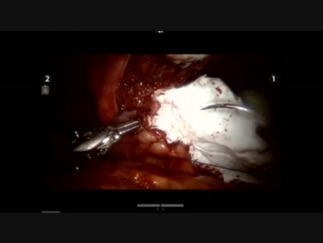 Trans-abdominal robotic repair of Morgagni hernia in an adult 