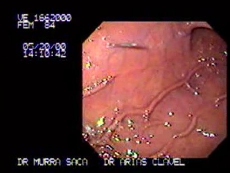 Percutaneous Endoscopic Gastrostomy (1 of 3)