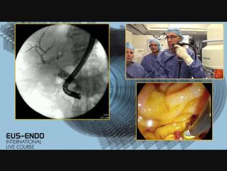 EUS followed by ERCP