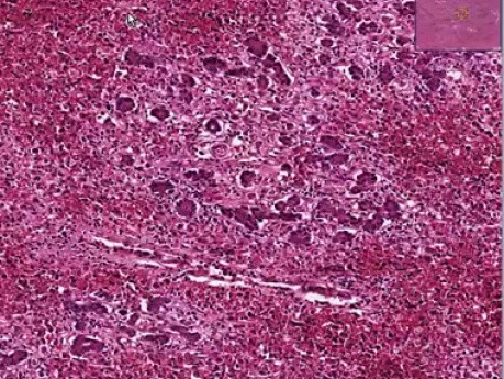 Viral hepatitis with fulminant necrosis
