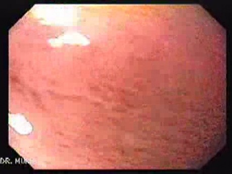 Brunner's Gland Hyperplasia (2 of 5)