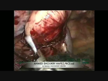 Esophageal Leiomyoma