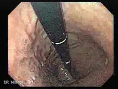 Angiodysplasia of the Duodenum (4 of 4)