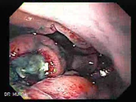 Multiple Irregular and Large Ulcers - Biopsy nr 3