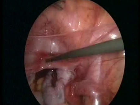 Right Ovarian Torsion Due to Dermoid Cyst in 8 Year Old Girl