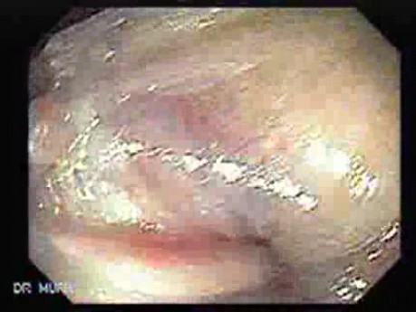 Anal Fissure (1 of 2)