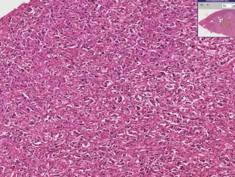 Adrenal - Pheochromocytoma