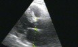 Cardiac Amyloidosis Echo Case by Dr Chatziathanasiou-diagnosis, ECG, Echo and Treatment