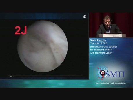 The Role of EPS for Treatment of BPH with Holmium-Laser - SMIT 2019