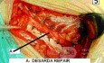 Inguinal hernia repair without mesh