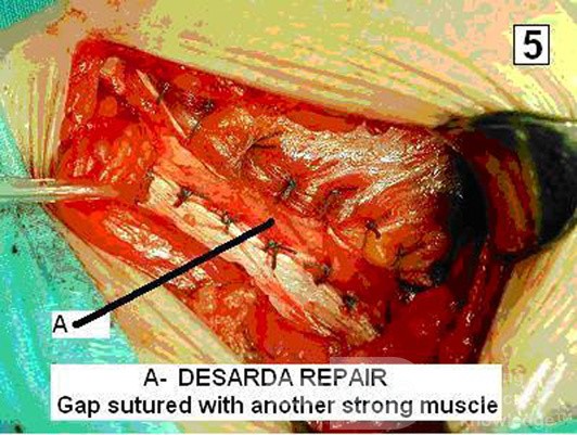 Inguinal hernia repair without mesh