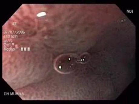 Gastric Erosion (3 of 3)