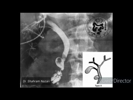 Choledochal Cyst Type II