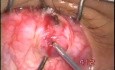 Atraumatic inferior oblique myomectomy