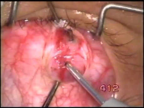 Atraumatic inferior oblique myomectomy