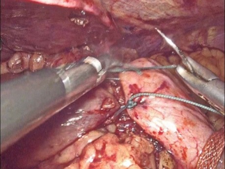 Antireflux Surgery for GERD Nissen's Fundoplication